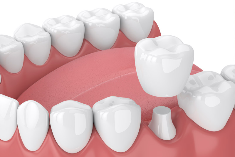 Dental Crowns in Keller