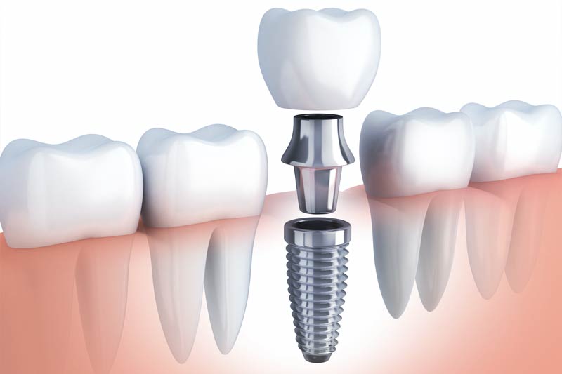 Implants Dentist in Keller