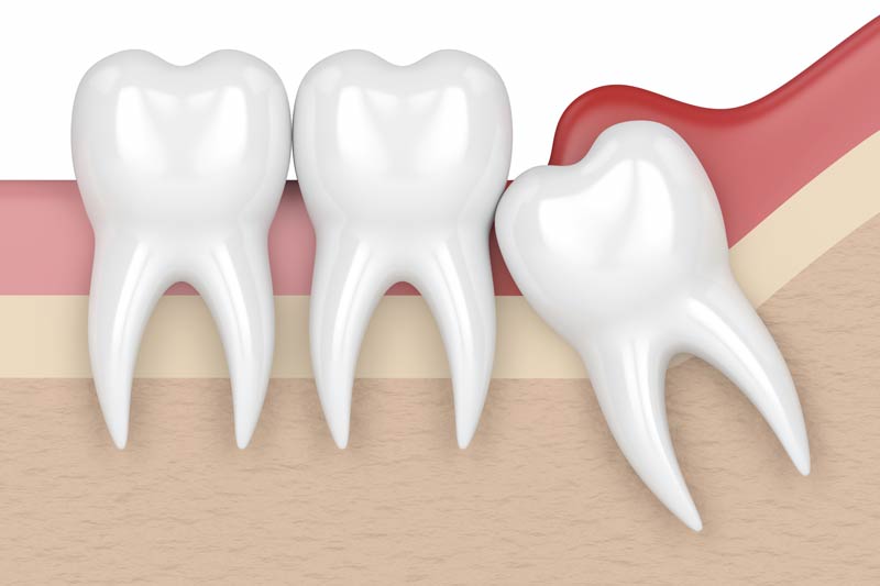 Wisdom Tooth Removal in Keller